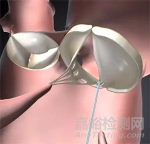 心臟瓣膜之二尖瓣技術(shù)解析