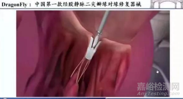 心臟瓣膜之二尖瓣技術(shù)解析