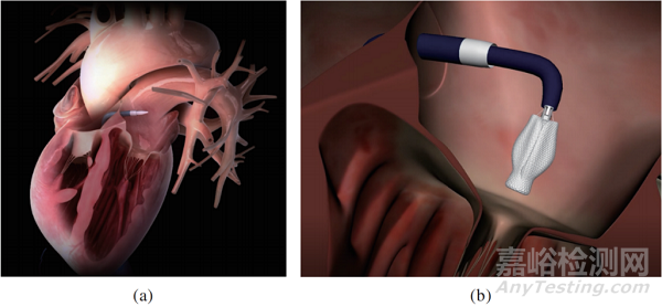 心臟瓣膜之二尖瓣技術(shù)解析