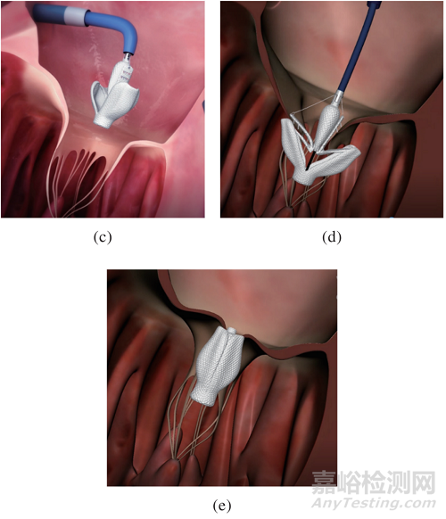 心臟瓣膜之二尖瓣技術(shù)解析