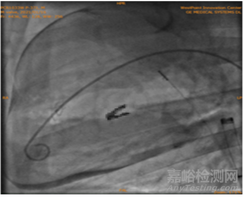 心臟瓣膜之二尖瓣技術(shù)解析