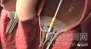 innostay：螺旋固定的二尖瓣置換產(chǎn)品可以適用各種大小生理結(jié)構(gòu)