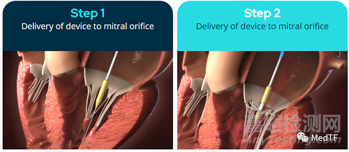 innostay：螺旋固定的二尖瓣置換產(chǎn)品可以適用各種大小生理結(jié)構(gòu)