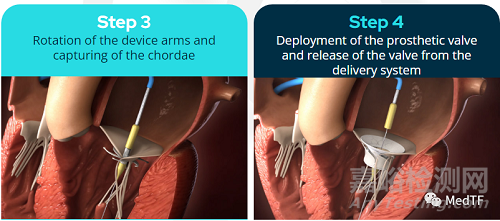 innostay：螺旋固定的二尖瓣置換產(chǎn)品可以適用各種大小生理結(jié)構(gòu)