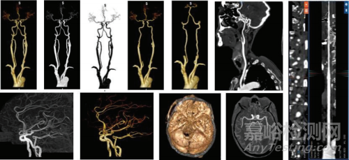 全球首張頭頸CTA AI三類證獲批！3min智能完成全流程，一站式解決卒中診療痛點(diǎn)