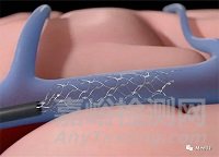 Stentrode：IDE研究歷史首位患者植入腦接口，搶先馬斯克