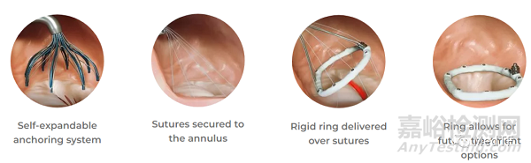 VALFIX：基于多線縫合的經(jīng)導(dǎo)管二尖瓣瓣環(huán)