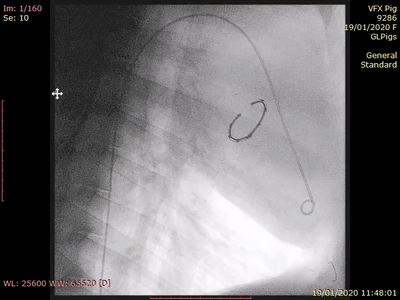 VALFIX：基于多線縫合的經(jīng)導(dǎo)管二尖瓣瓣環(huán)