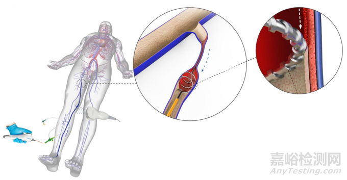 InVera：針對(duì)所有慢性靜脈疾病的微創(chuàng)、有效、無(wú)痛、快速的靜脈內(nèi)治療器械