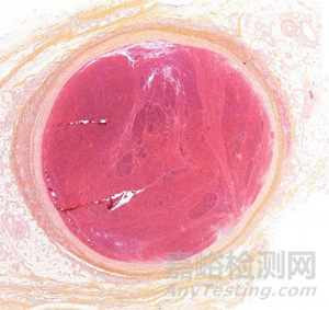 InVera：針對(duì)所有慢性靜脈疾病的微創(chuàng)、有效、無(wú)痛、快速的靜脈內(nèi)治療器械