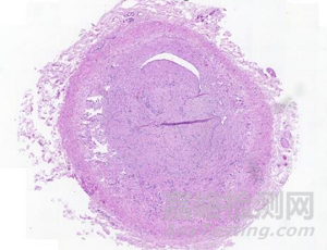 InVera：針對(duì)所有慢性靜脈疾病的微創(chuàng)、有效、無(wú)痛、快速的靜脈內(nèi)治療器械