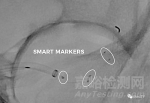 NeVa:第四代取栓支架---捕獲硬質(zhì)且大塊的血栓