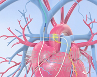 CPNS:心肺神經(jīng)刺激治療ADHF