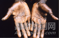 猴痘治療相關(guān)藥物介紹