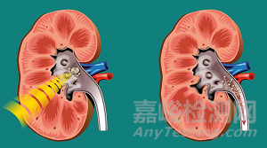 Shockwave(沖擊波球囊)的技術與國產(chǎn)化