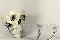 2022年全球3D打印醫(yī)療器械市場如何？