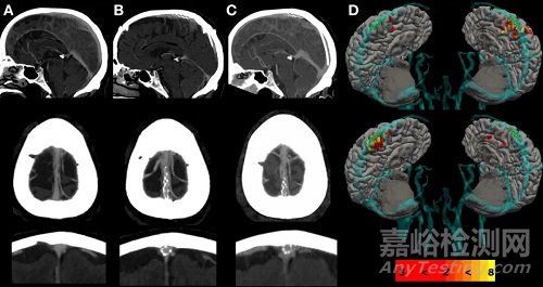 介入腦機接口支架