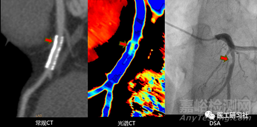 全球CT技術(shù)發(fā)展過程與趨勢