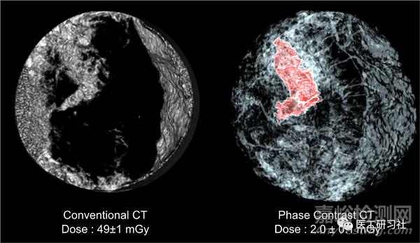 全球CT技術(shù)發(fā)展過程與趨勢