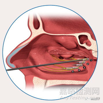 RhinAer：溫控射頻消融治療慢性鼻炎 顯示出長期有效