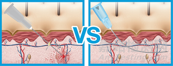 韓國(guó)Feel Tech美容鈍針獲NMPA批準(zhǔn)上市