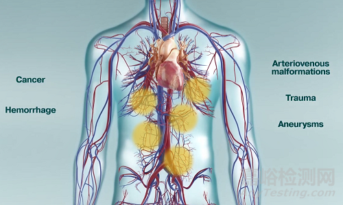 LOBO：FDA批準(zhǔn)大號(hào)血管封堵器