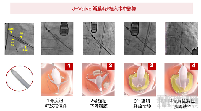 2022心血管研究報(bào)告：技術(shù)升級(jí)、多元?jiǎng)?chuàng)新是破局關(guān)鍵