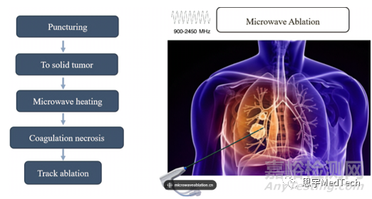 腫瘤消融技術(shù)7大核心技術(shù)