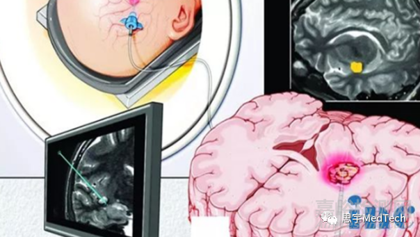 腫瘤消融技術(shù)7大核心技術(shù)