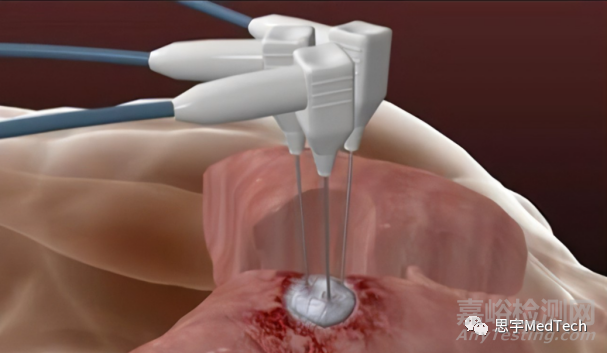 腫瘤消融技術(shù)7大核心技術(shù)