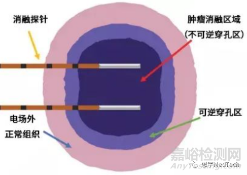 腫瘤消融技術(shù)7大核心技術(shù)