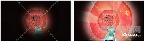 Saneso 360°：360°視野的消化內(nèi)鏡 顛覆奧林巴斯