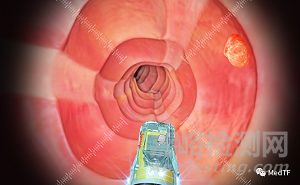 Saneso 360°：360°視野的消化內(nèi)鏡 顛覆奧林巴斯
