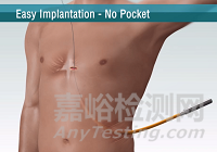 ISSD:可充電無(wú)導(dǎo)線植入式皮下除顫器 門診即可完成手術(shù)