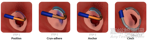 CryoCinch：冷凍定位的瓣環(huán)修復(fù) 治療MR和TR