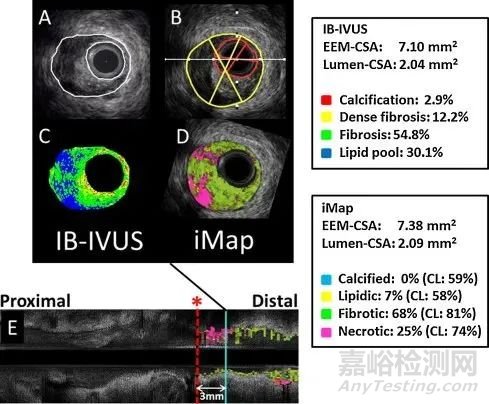 血管內(nèi)超聲（IVUS）的器械構(gòu)成及技術(shù)趨勢