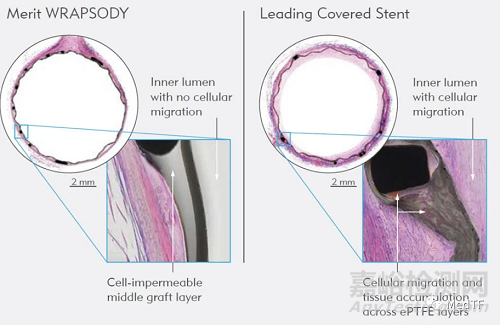 Wrapsody:不透細(xì)胞的覆膜支架 避免/減少再狹窄