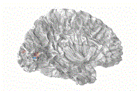 清華團(tuán)隊(duì)開發(fā)微創(chuàng)植入腦機(jī)接口，年底進(jìn)入臨床