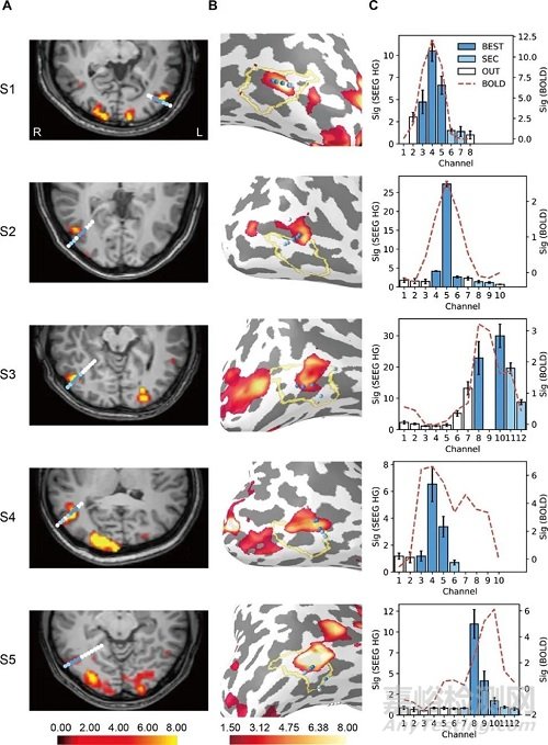 清華團(tuán)隊(duì)開發(fā)微創(chuàng)植入腦機(jī)接口，年底進(jìn)入臨床