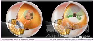 SING IMT：可植入“望遠(yuǎn)鏡”完成美國第一例臨床