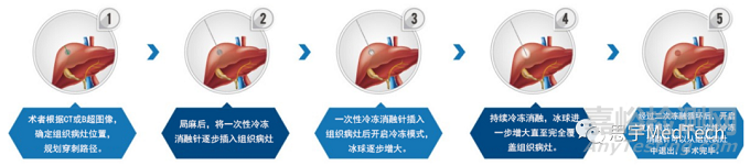 冷凍消融市場、產(chǎn)品和公司盤點(diǎn)