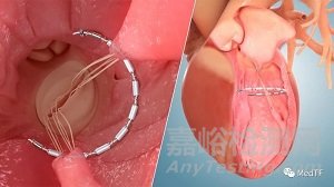 AccuCinch:首款經(jīng)皮修復(fù)心室治療心衰器械獲FDA授予“突破性設(shè)備”稱號(hào)