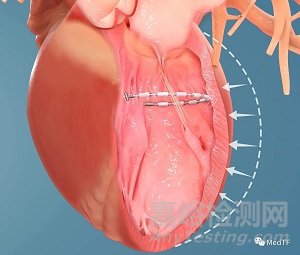AccuCinch:首款經(jīng)皮修復(fù)心室治療心衰器械獲FDA授予“突破性設(shè)備”稱號(hào)