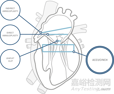 AccuCinch:首款經(jīng)皮修復(fù)心室治療心衰器械獲FDA授予“突破性設(shè)備”稱號(hào)