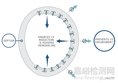 AccuCinch:首款經(jīng)皮修復(fù)心室治療心衰器械獲FDA授予“突破性設(shè)備”稱號(hào)