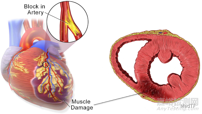 Booster:螺旋球囊完成首例臨床 急性心肌梗死希望