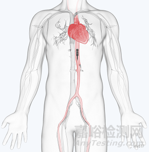ModulHeart：允許疊加經(jīng)皮管心臟泵的完成首次人體研究