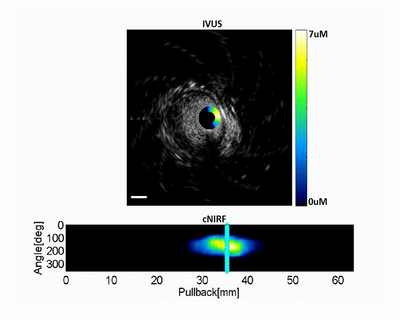 I3 NIRF-IVUS:近紅外光譜和超聲二合一血管造影導(dǎo)管