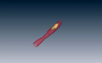 I3 NIRF-IVUS:近紅外光譜和超聲二合一血管造影導(dǎo)管