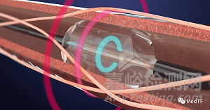 Paradise:超聲RDN產(chǎn)品IDE研究結(jié)果達到主要終點